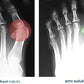 IMPORTIKAAH-Silicon-Toe-Separator-orthopedic-brace-pair