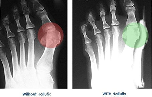 IMPORTIKAAH-Silicon-Toe-Separator-orthopedic-brace-pair